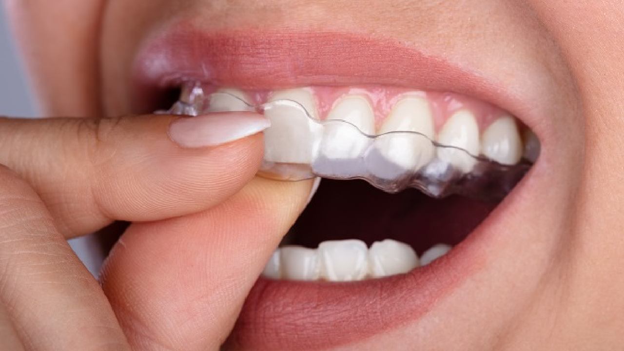 Tooth Alignment : టూత్ అలైన్మెంట్ గురించి తెలుసుకోండి..